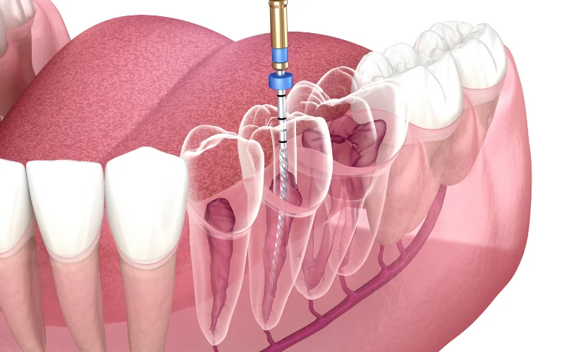 CLINICA HOLGUIN DENTISTA Endodoncia